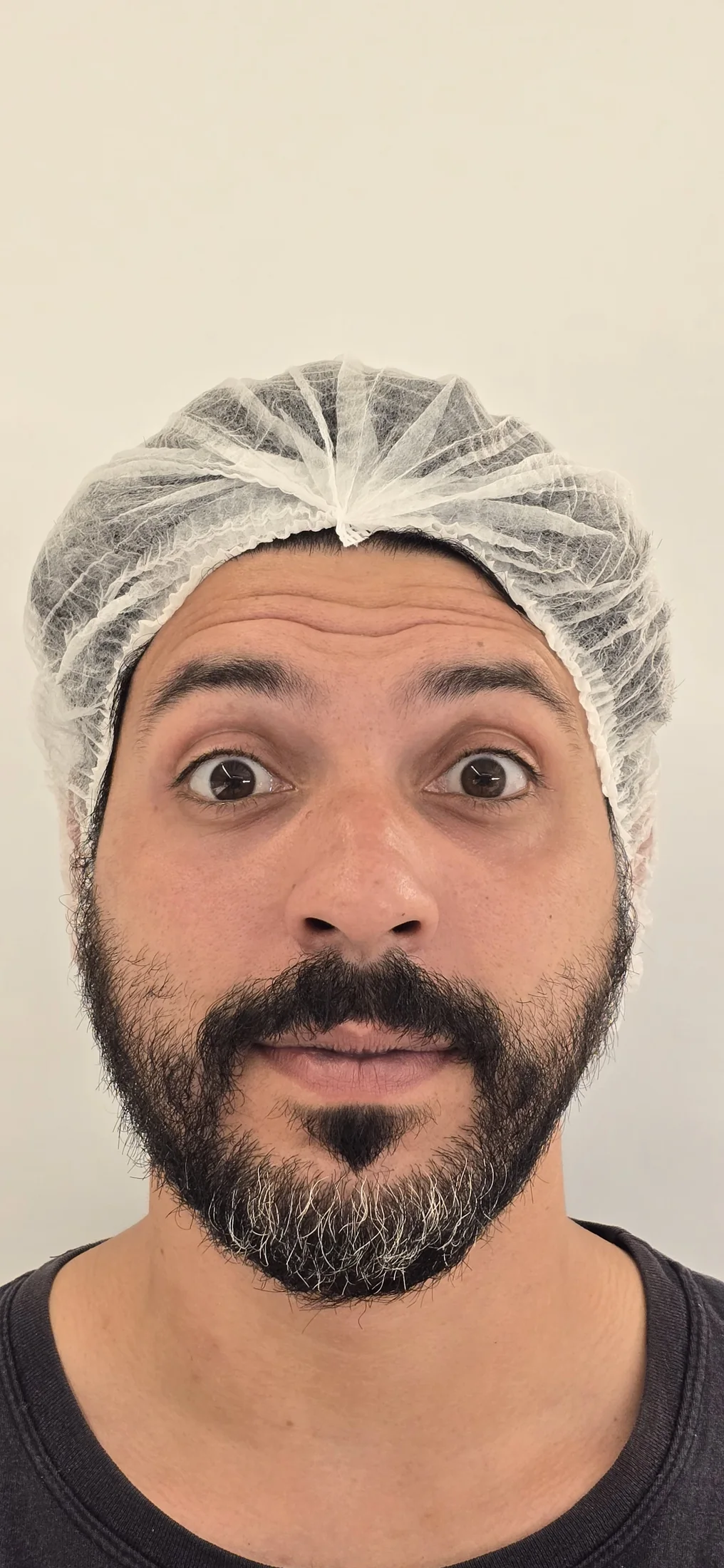 Resultado antes do Botox